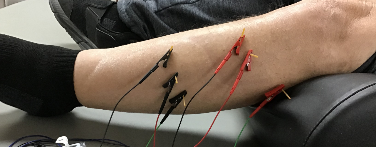 dry-needling—joint-effort-physical-therapy-hot-springs-ar